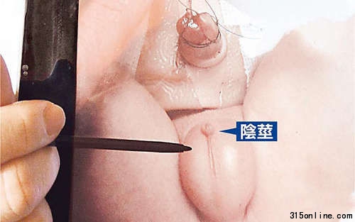 男嬰生殖器約0.2厘米長(zhǎng)(筆指處),一粒米大小,不到平均長(zhǎng)度2.9厘米的十分之一。圖片來源:臺(tái)灣媒體 男嬰生殖器約0.2厘米長(zhǎng)(筆指處),一粒米大小,不到平均長(zhǎng)度2.9厘米的十分之一。圖片來源:臺(tái)灣媒體