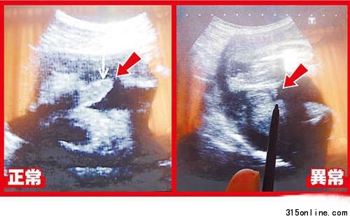 超聲波可看到胎兒生殖器,左圖箭頭處為28周正常男嬰生殖器:右圖箭頭處為異常男嬰28周時(shí)生殖器畫面。圖片來源:臺(tái)灣媒體 超聲波可看到胎兒生殖器,左圖箭頭處為28周正常男嬰生殖器:右圖箭頭處為異常男嬰28周時(shí)生殖器畫面。圖片來源:臺(tái)灣媒體