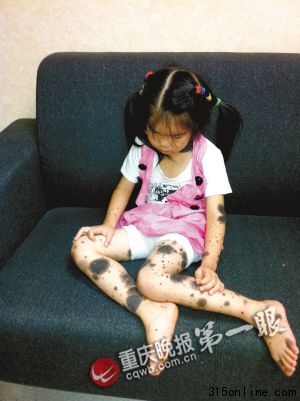 五歲女孩兩三年里滿身長痣需實(shí)施數(shù)次手術(shù)(圖)