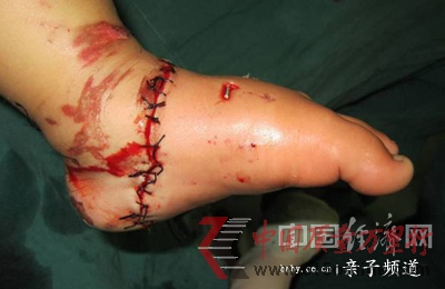 電瓶車咬斷女童左腳醫(yī)生呼吁強(qiáng)制安裝防護(hù)網(wǎng)(圖)